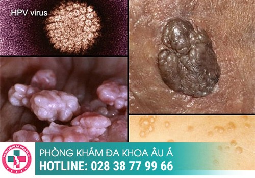 Nổi mụn ở vùng kín là bệnh gì?