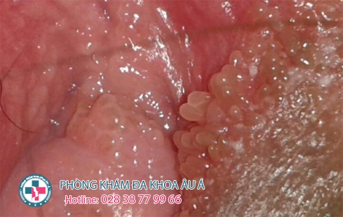 mụn cóc sinh dục