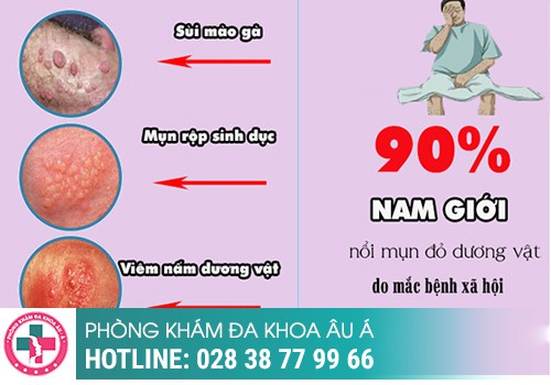 Nguyên nhân gây nổi mụn trắng ở bìu tinh hoàn