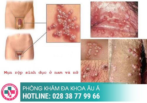 Nổi mụn trứng cá ở vùng kín nữ là bị bệnh gì?