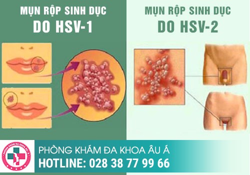 nổi mụn ở môi lớn, mọc mụn ở môi bé