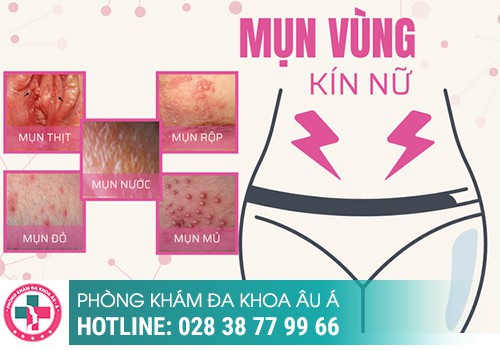 Nổi mụn nước ở vùng kín là bệnh gì?