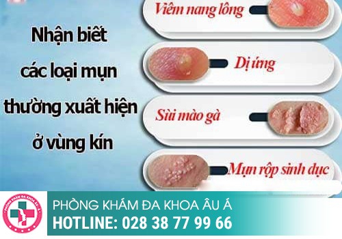 Nguyên nhân nổi mụn li ti ở vùng kín