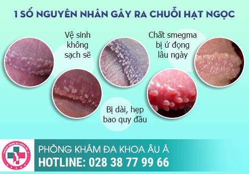 Cách chữa hạt ngọc dương vật hiệu quả cho nam giới