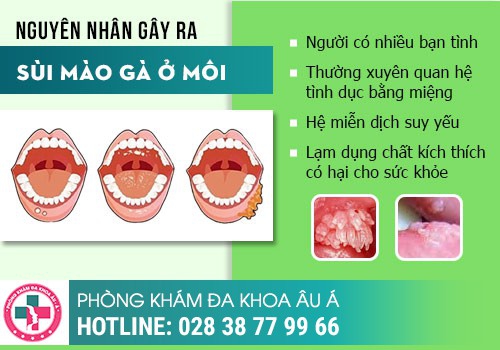 NGUYÊN NHÂN DẪN ĐẾN BIỂU HIỆN CỦA SÙI MÀO GÀ Ở CỔ HỌNG