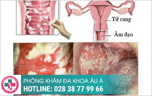 nỗi hạch ở vùng kín nữ có sao không