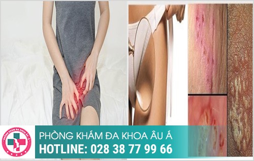 nỗi hạch ở vùng kín nữ có sao không