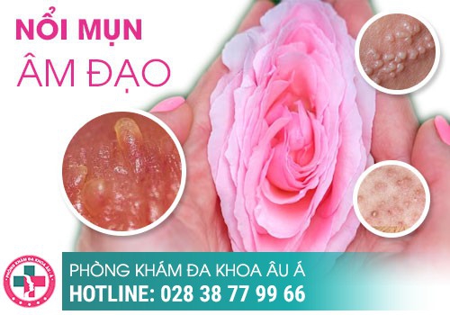 Cách chữa mụn nước ở vùng kín hiệu quả