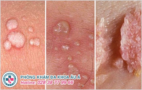Nguyên Nhân Nổi Mụn Bộ Phận Sinh Dục Nam