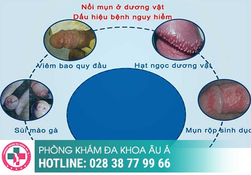 vùng kín mọc mụn