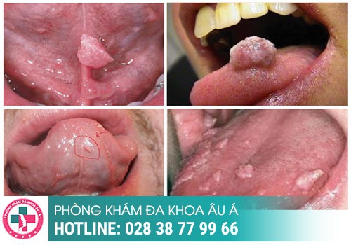 Sùi mào gà ở lưỡi