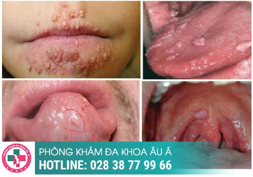 dấu hiệu sùi mào gà ở miệng
