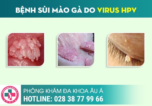 Nổi mụn nước ở vùng kín là bệnh gì?