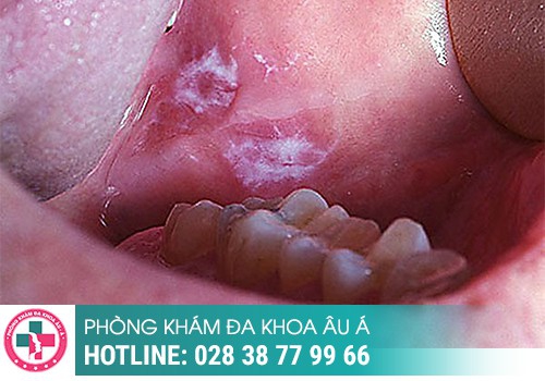Hình ảnh sùi mào gà ở môi giai đoạn đầu