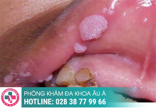 Hình ảnh sùi mào gà ở môi giai đoạn đầu