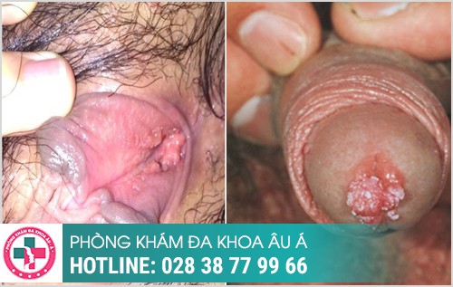 Một số hình ảnh sùi mào gà ở lỗ sáo thường gặp