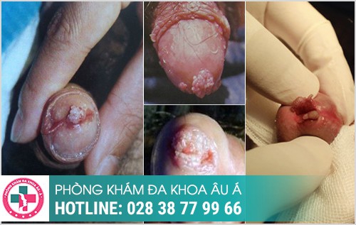 Một số hình ảnh sùi mào gà ở lỗ sáo thường gặp