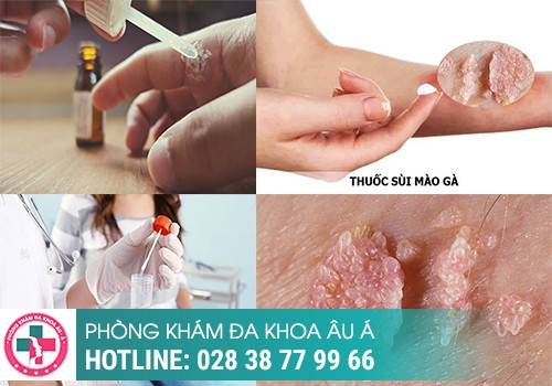 Cách chữa mụn ở vùng kín hiệu quả