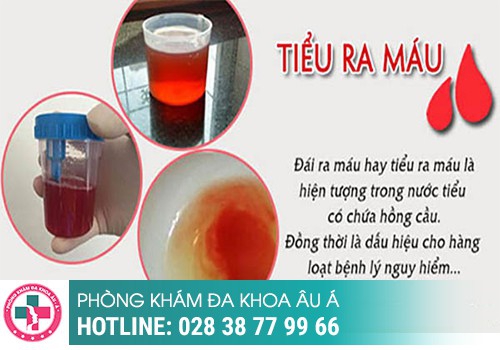 Tiểu buốt ra máu – coi chừng bệnh hiểm nghèo