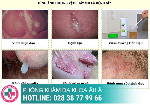 tiểu ra mủ