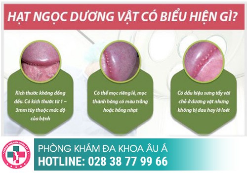 Hình ảnh hạt ngọc dương vật