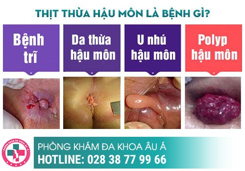 Hậu môn nổi thịt và ngứa là dấu hiệu bệnh gì?