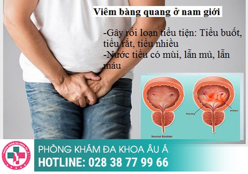 Cẩn thận với hiện tượng tiểu ra mủ để tránh nguy cơ vô sinh