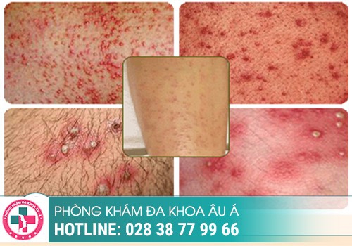 mụn sinh dục