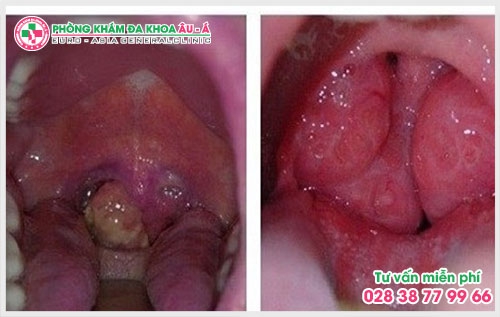 Theo những thống kê gần đây cứ 10 ca điều trị về bệnh xã hội lại có 6 ca liên quan đến bệnh sùi mào gà. Vậy biểu hiện của bệnh sùi mào gà ở cổ họng như thế nào? 