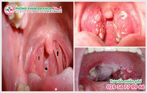 Theo những thống kê gần đây cứ 10 ca điều trị về bệnh xã hội lại có 6 ca liên quan đến bệnh sùi mào gà. Vậy biểu hiện của bệnh sùi mào gà ở cổ họng như thế nào? 