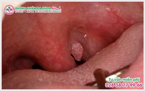 Theo những thống kê gần đây cứ 10 ca điều trị về bệnh xã hội lại có 6 ca liên quan đến bệnh sùi mào gà. Vậy biểu hiện của bệnh sùi mào gà ở cổ họng như thế nào? 