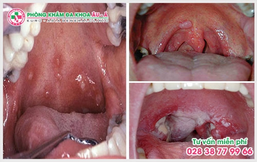 Theo những thống kê gần đây cứ 10 ca điều trị về bệnh xã hội lại có 6 ca liên quan đến bệnh sùi mào gà. Vậy biểu hiện của bệnh sùi mào gà ở cổ họng như thế nào? 